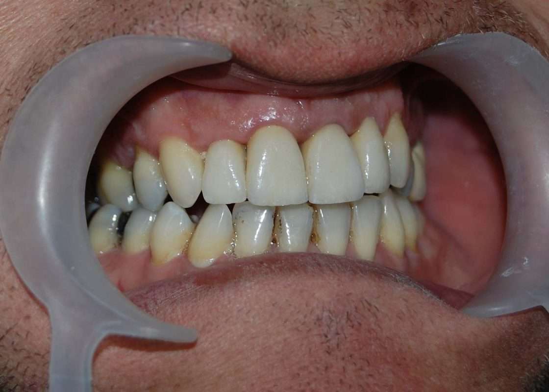 corona zirconio 01 final