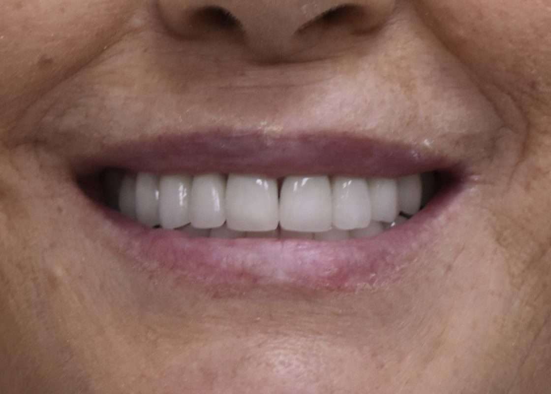 corona zirconio 02 final