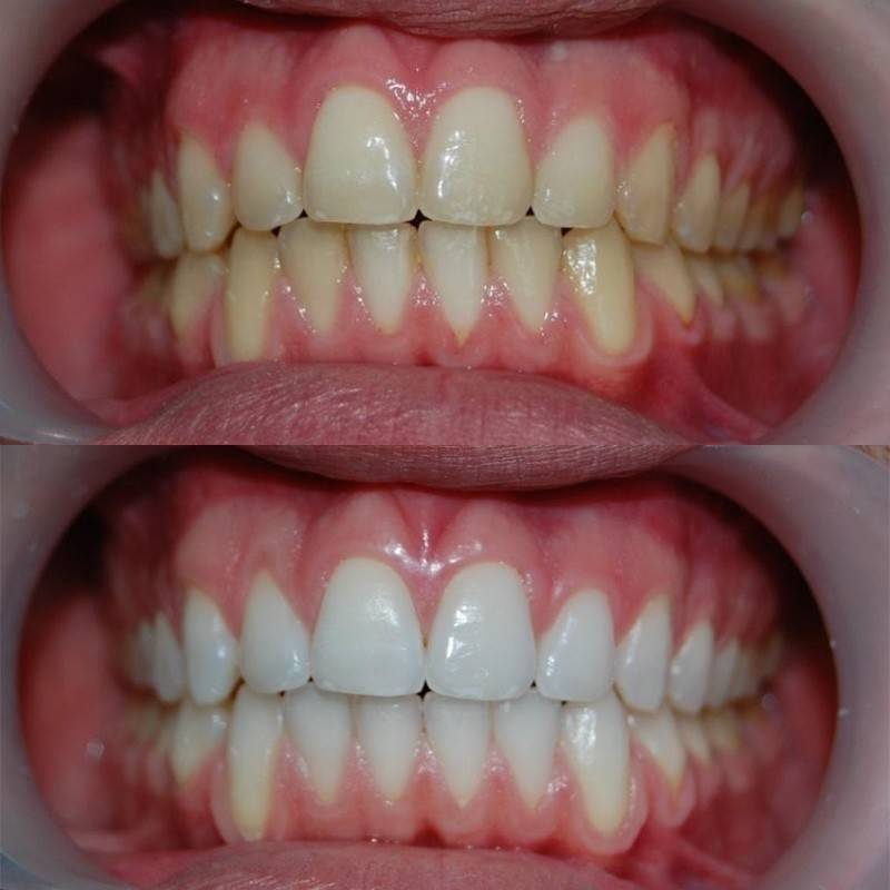 blanqueamiento dental