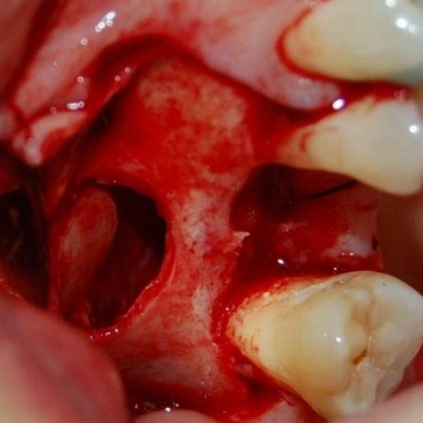 tratamiento de implante dental4