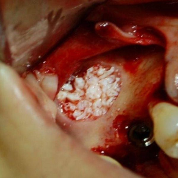 tratamiento de implante dental5