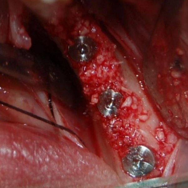 tratamiento de implante dental7