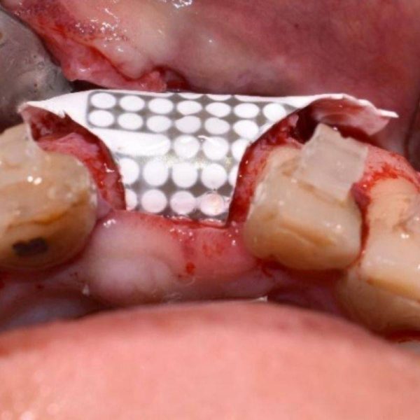tratamiento de implante dental8