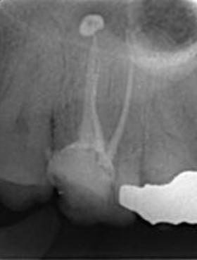 endodoncia