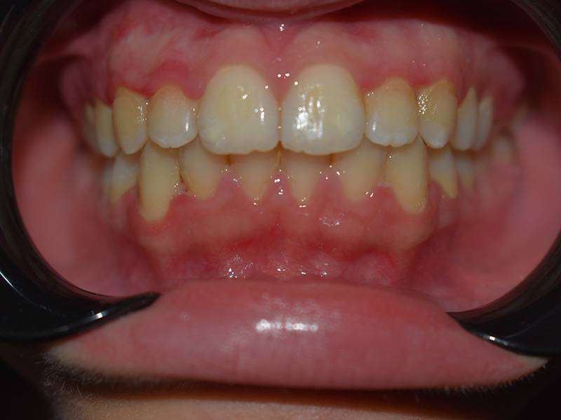 gingivitis