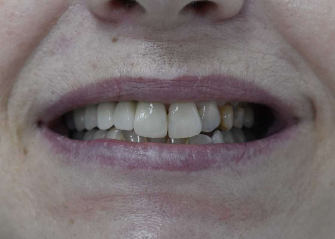 implante protesis zirconio final