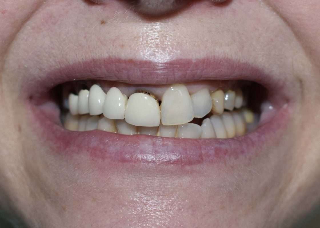 implante protesis zirconio inicial