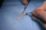 injerto tuberosidad (2)