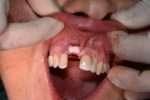 injerto tuberosidad (3)