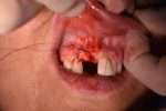 injerto tuberosidad (4)