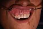 injerto tuberosidad (5)
