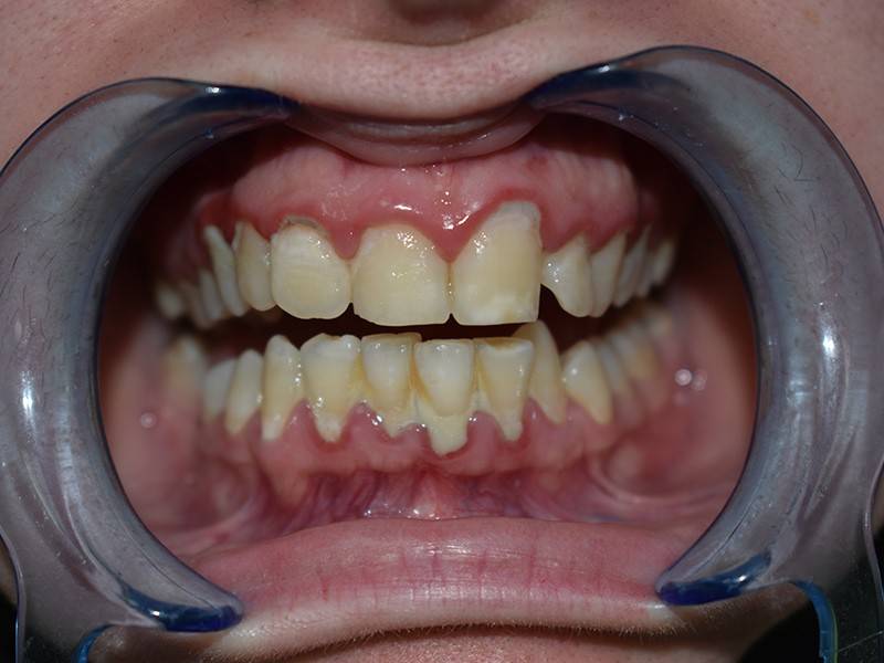 periodontitis