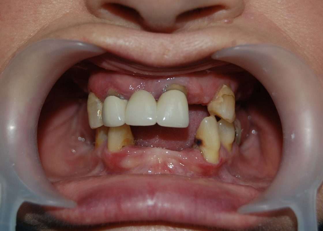 reahibilitacion implantes injerto hueso inicial
