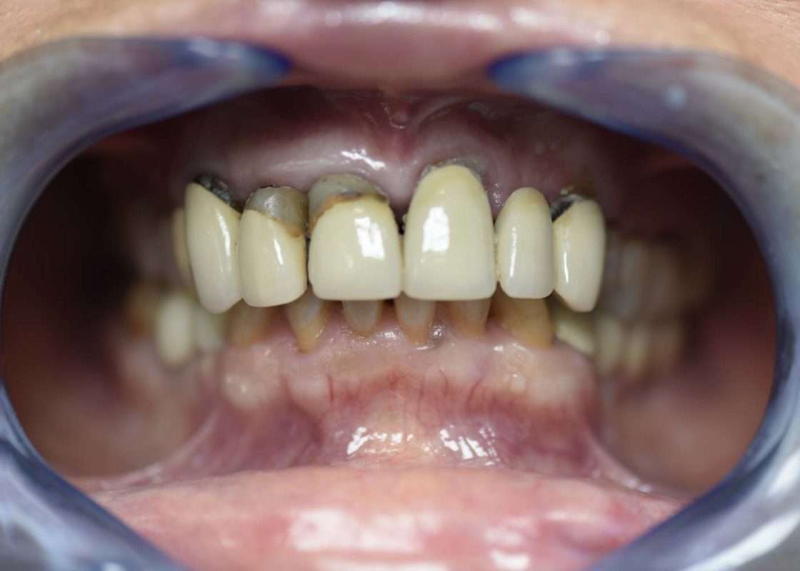 rehabilitacion fija implantes inicial