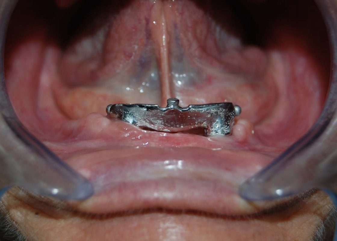 sobredentadura inf anclaje barra inicial